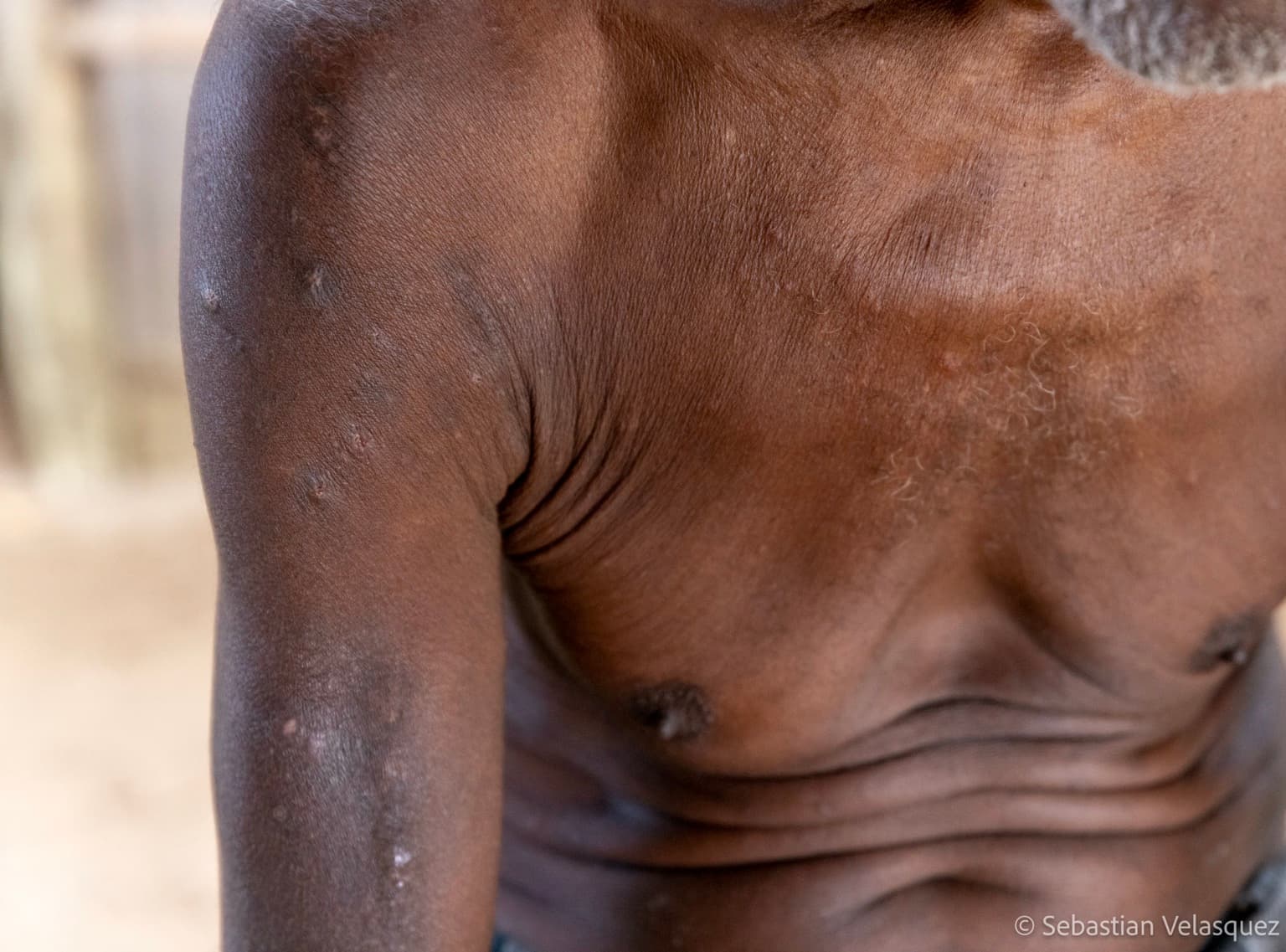 Skin irritations reportedly caused by recent contact with the waters off New Ireland’s east coast. Image ©Sebastian Velasquez.